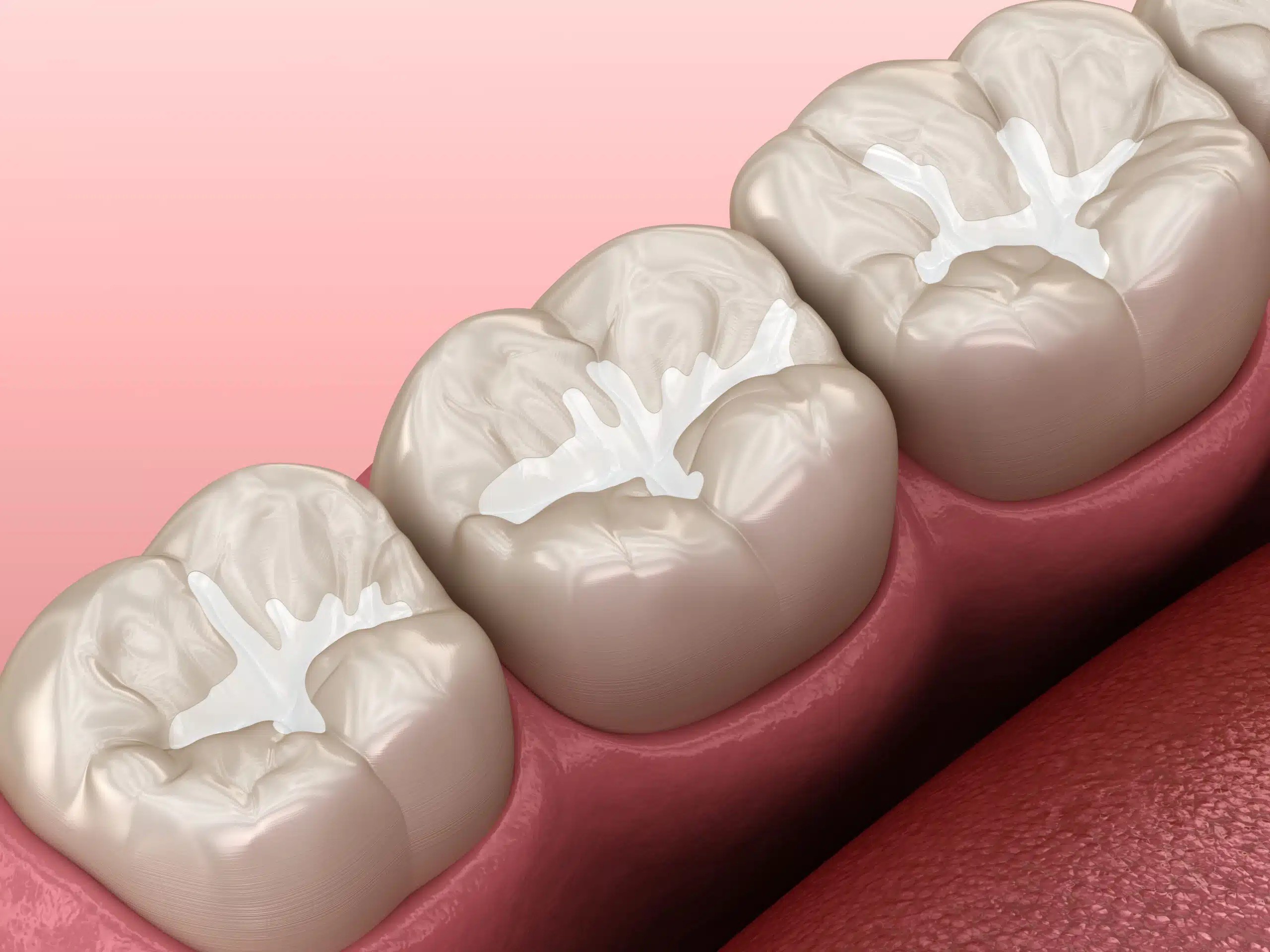 Fillings and Sealants