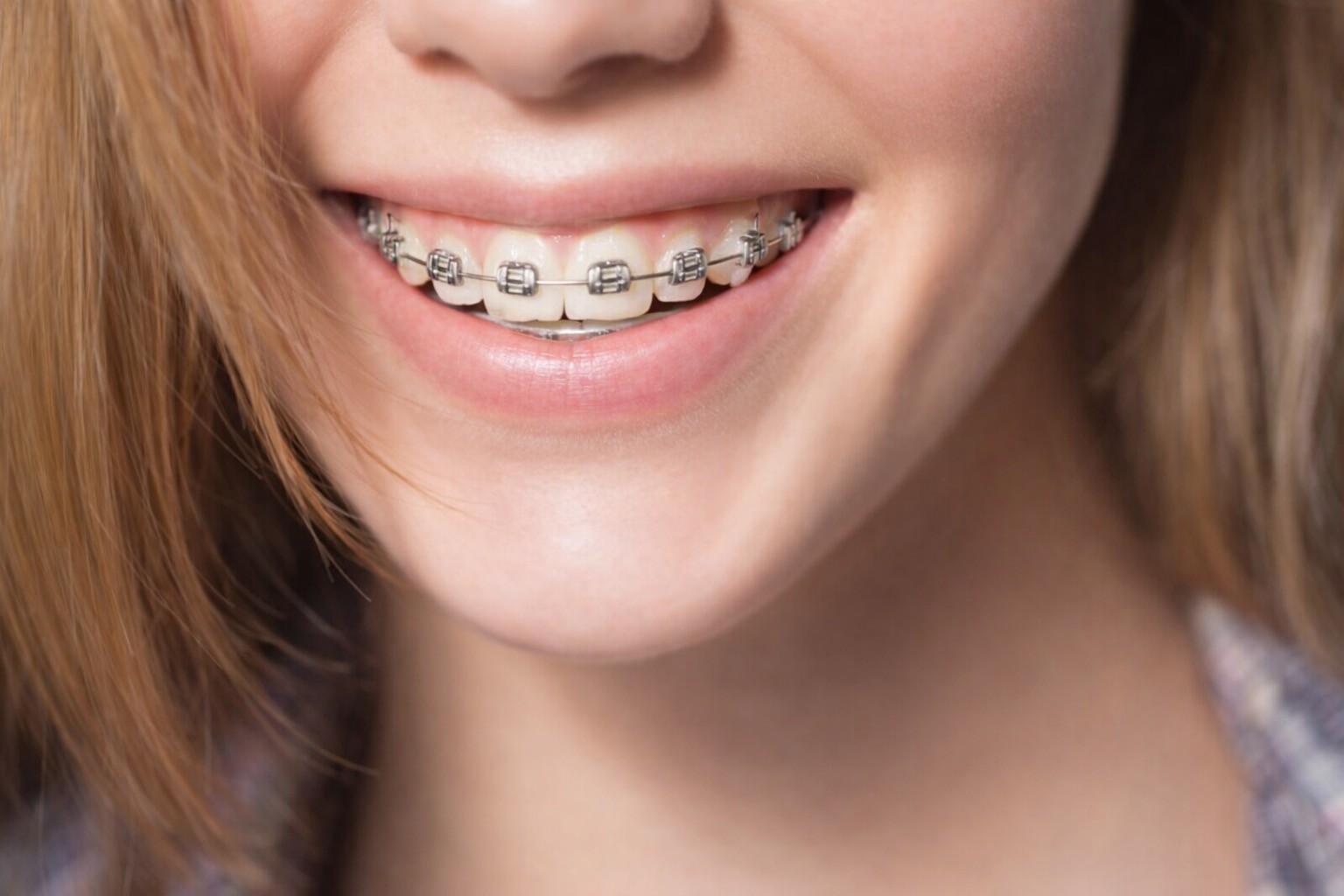Self-Ligating Braces
