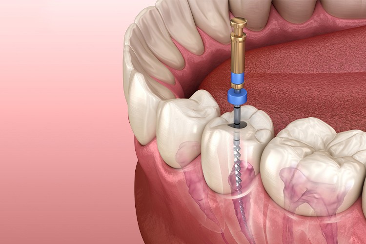 Root Canal