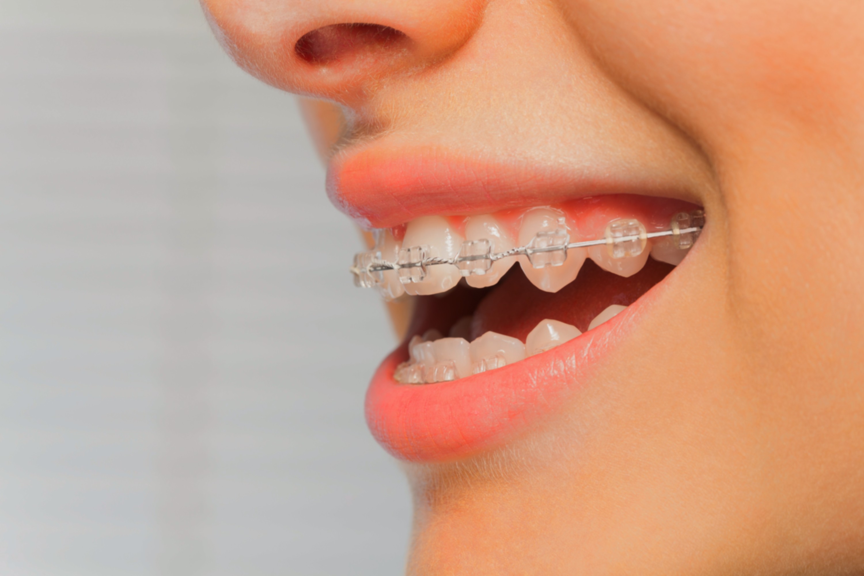Braces