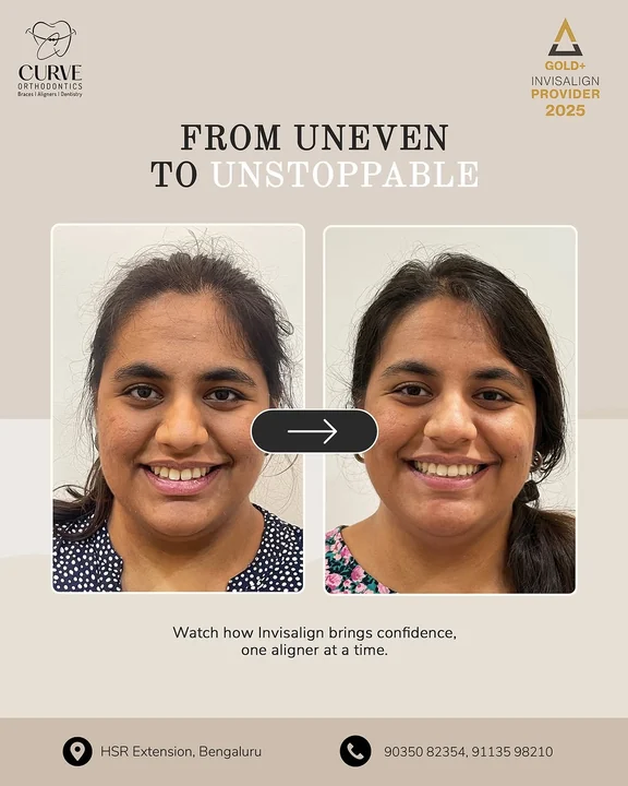 From uneven to unstoppable — watch how Invisalign brings confidence, one aligner at a time. 💫 At Curve, we’re helping…