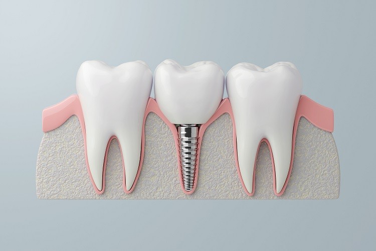 Dental Implants